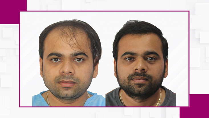 Before-After3