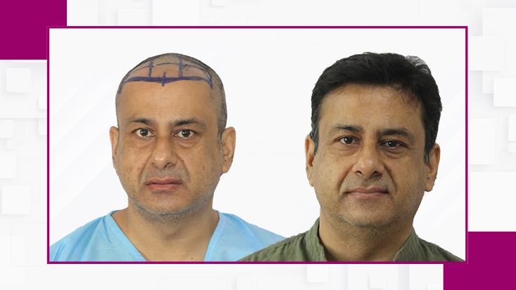 Before-After5