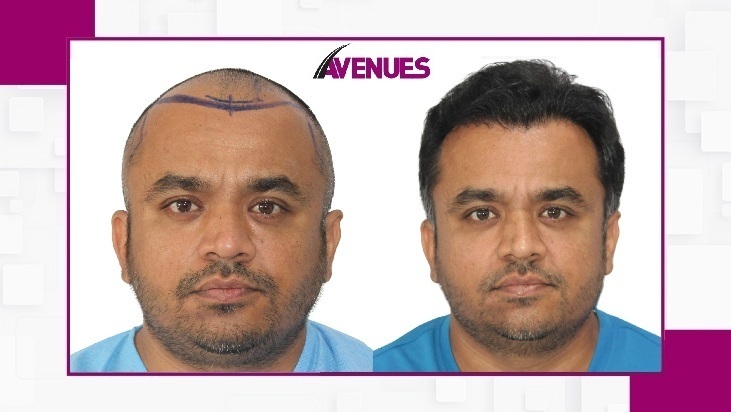 Avenues-Before-After-1