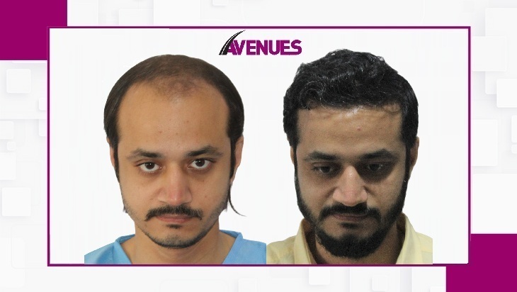 Avenues-Before-After-Template - Main - 1