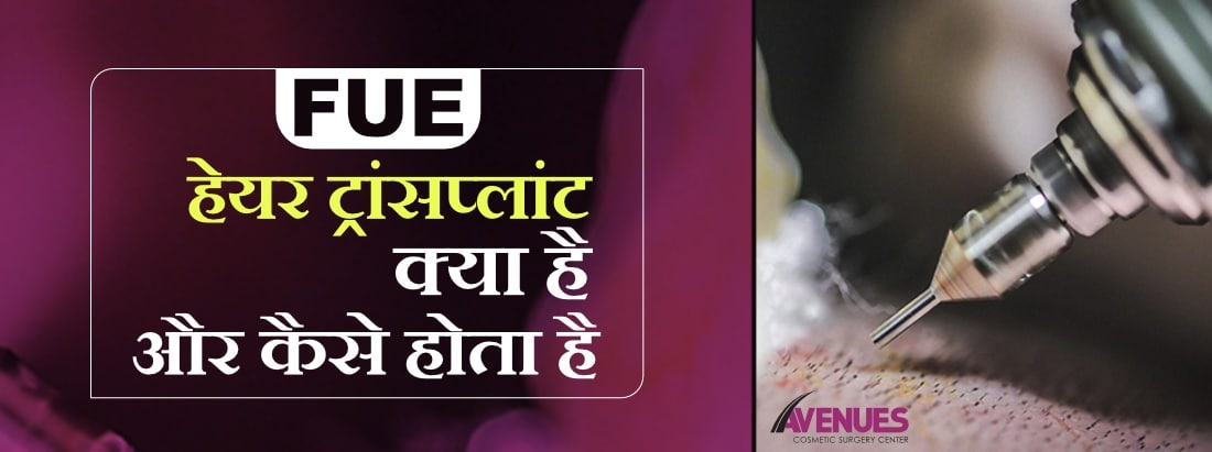 What Is FUE Hair Transplant in hindi