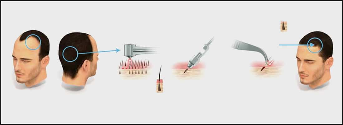 The Art & Science Of FUE Hair Transplant