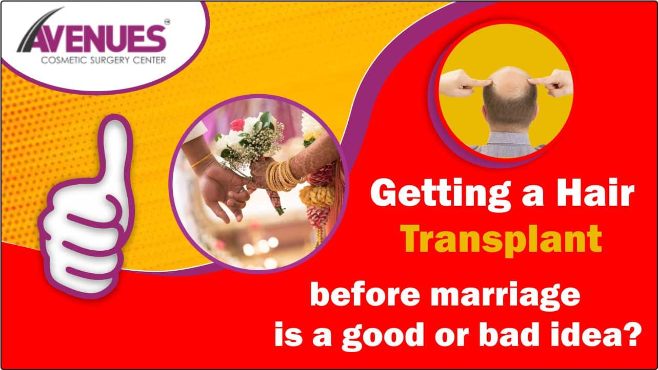 Getting a Hair Transplant before marriage is a good or bad idea