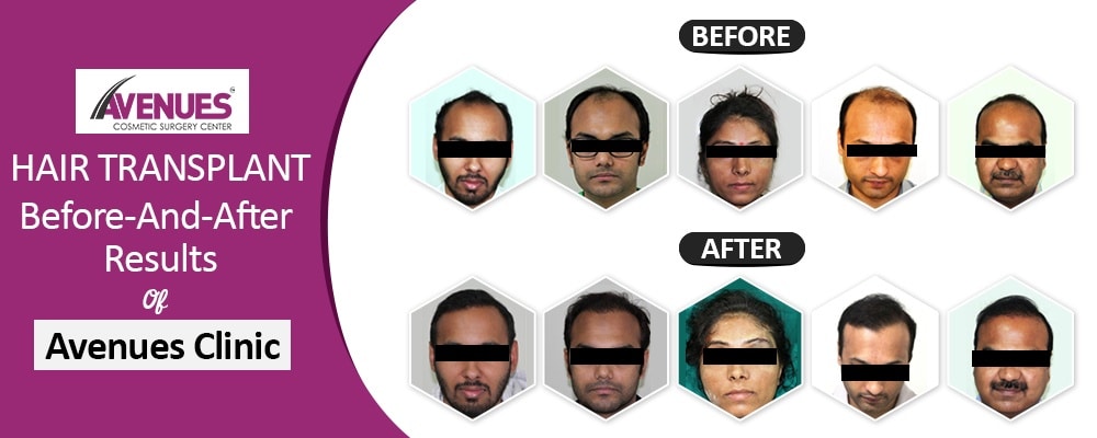 Hair Transplant Before and After Results of Avenues Clinic
