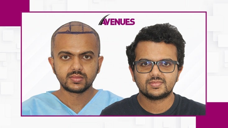 India Leads the Race for Lush Hair with Advanced Hair Transplant Solutions