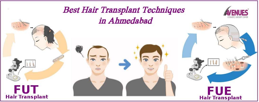 Best Hair Transplant Techniques in Ahmedabad