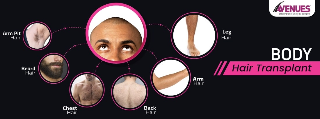 Hair Transplant Using Body Hair