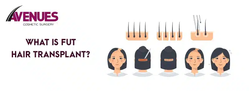 What Is Fut Hair Transplant?