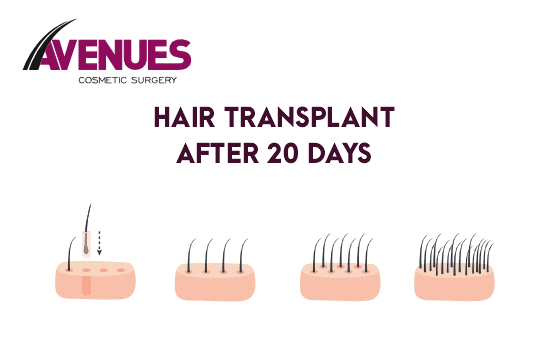 Hair Transplant After 20 Days