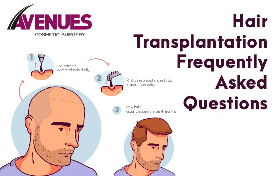 Hair Transplant Frequently Asked Questions
