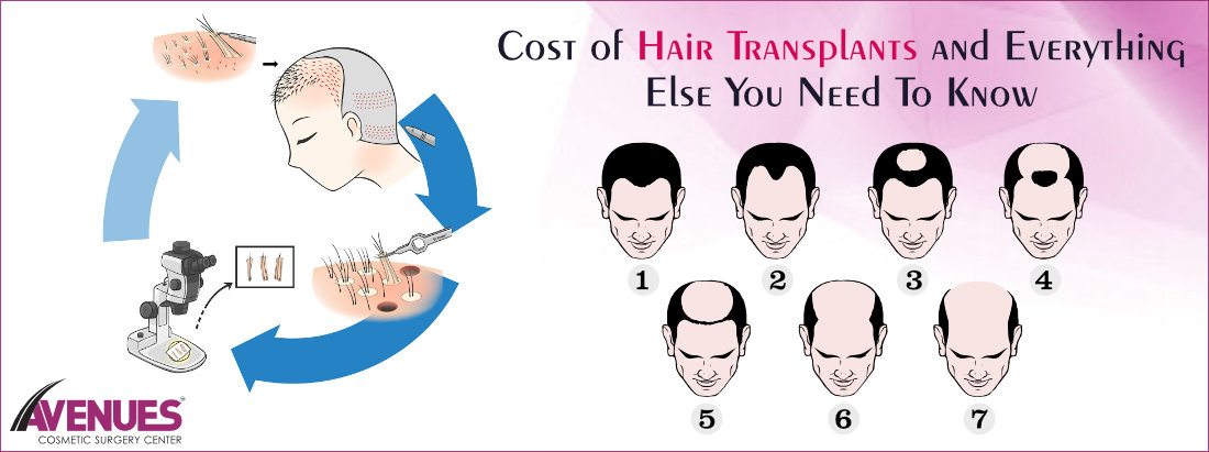 Cost of Hair Transplants and Everything Else You Need To Know
