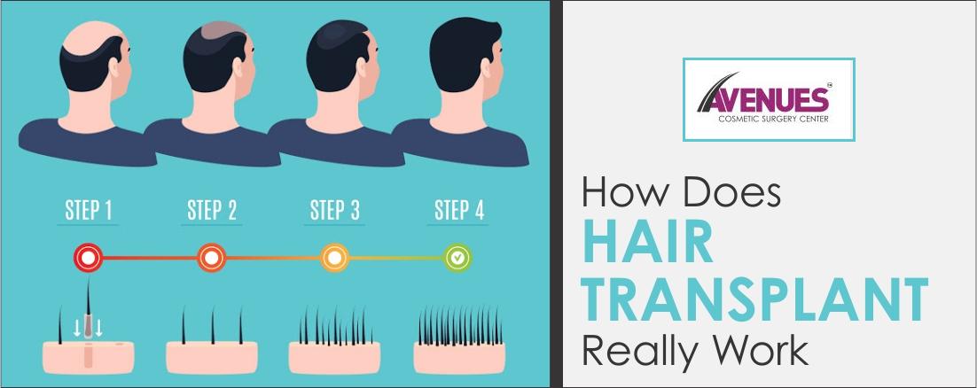 Best Hair Transplant in Ahmedabad and how does hair transplant really work?
