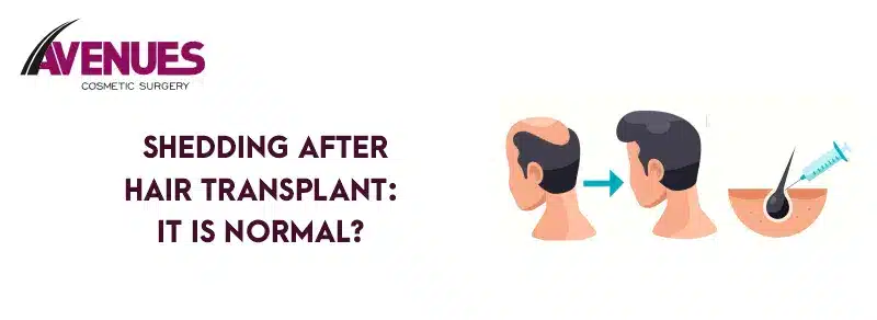 Shedding after hair transplant: It is normal?
