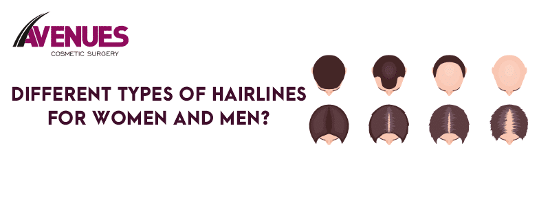 Different Types of Hairlines for Women and Men