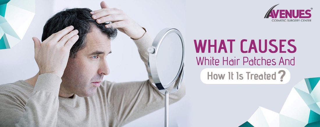 What causes White Hair Patches and how it is treated?