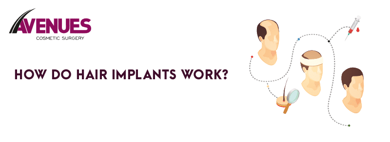 How Do Hair Implants Work? Understanding Procedure and Cost