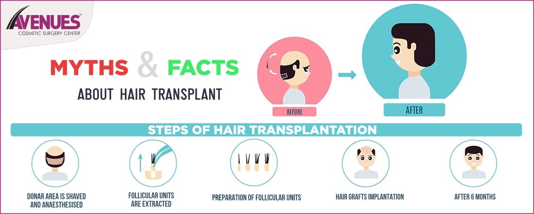 Myths and Facts about Hair Transplant