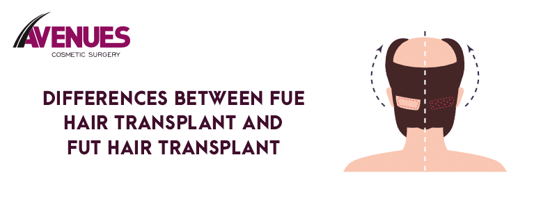 Differences Between Fue Hair Transplant and Fut Hair Transplant