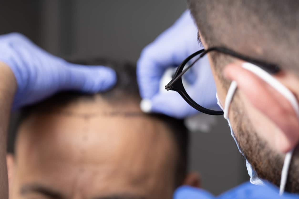 Best Hair Transplant Doctors in India