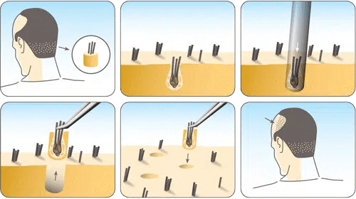 How Technology is Rewriting the Narrative of Hair Loss