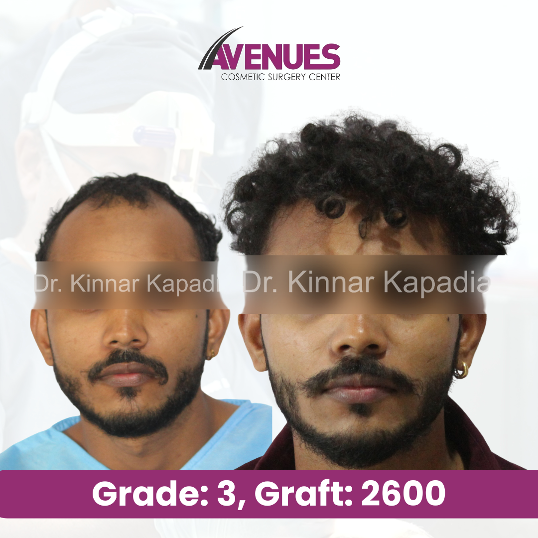 Grade_ 2, Graft_ 2500 (2)