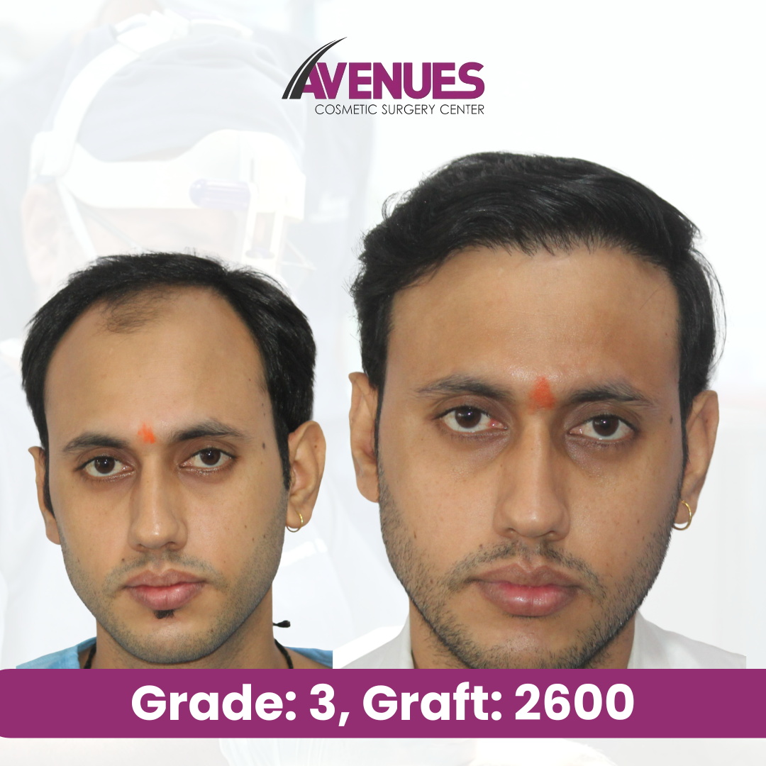 Grade_ 3, Graft_ 2600