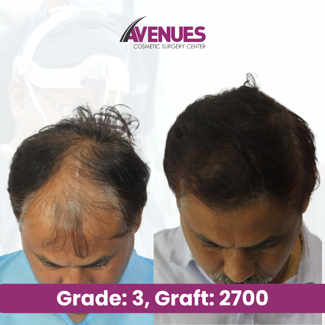 Grade_ 3, Graft_ 2700 (2)