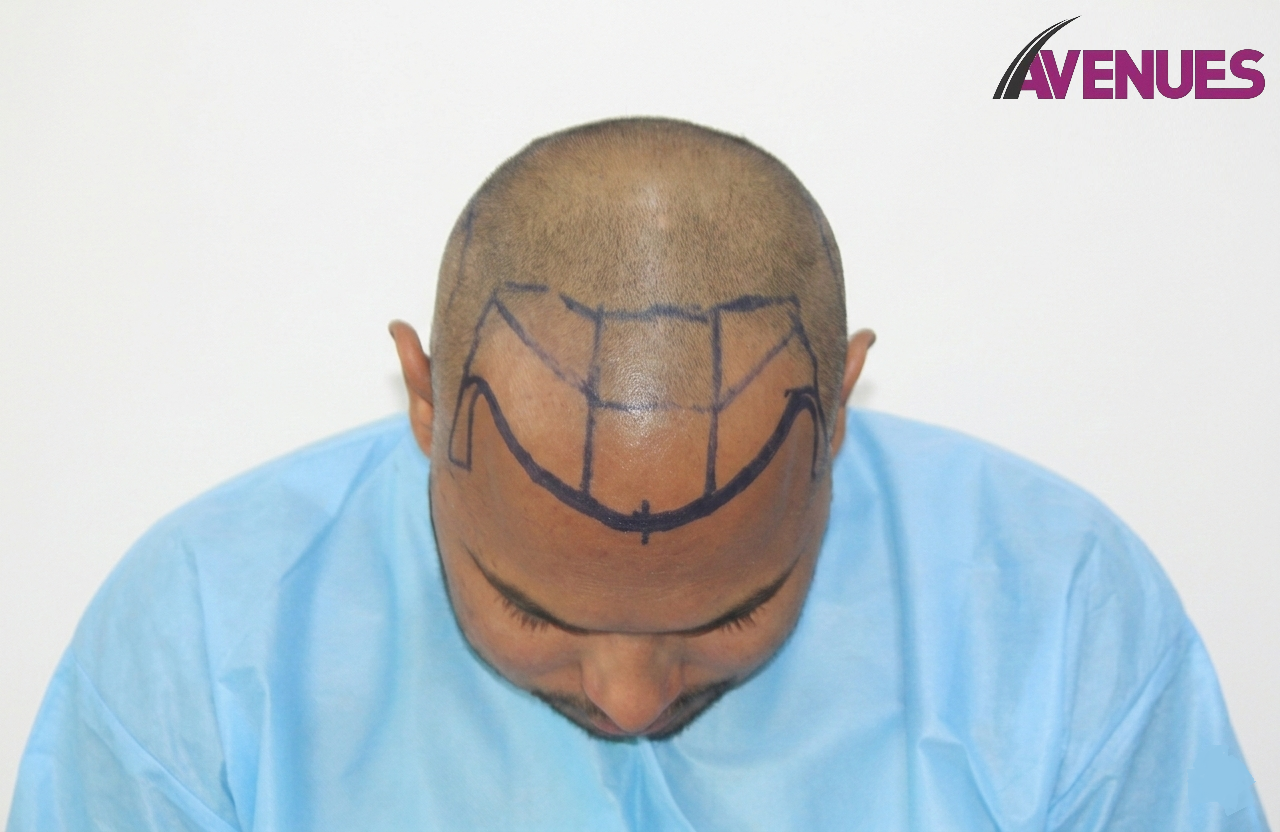 Front Head Down - Planning