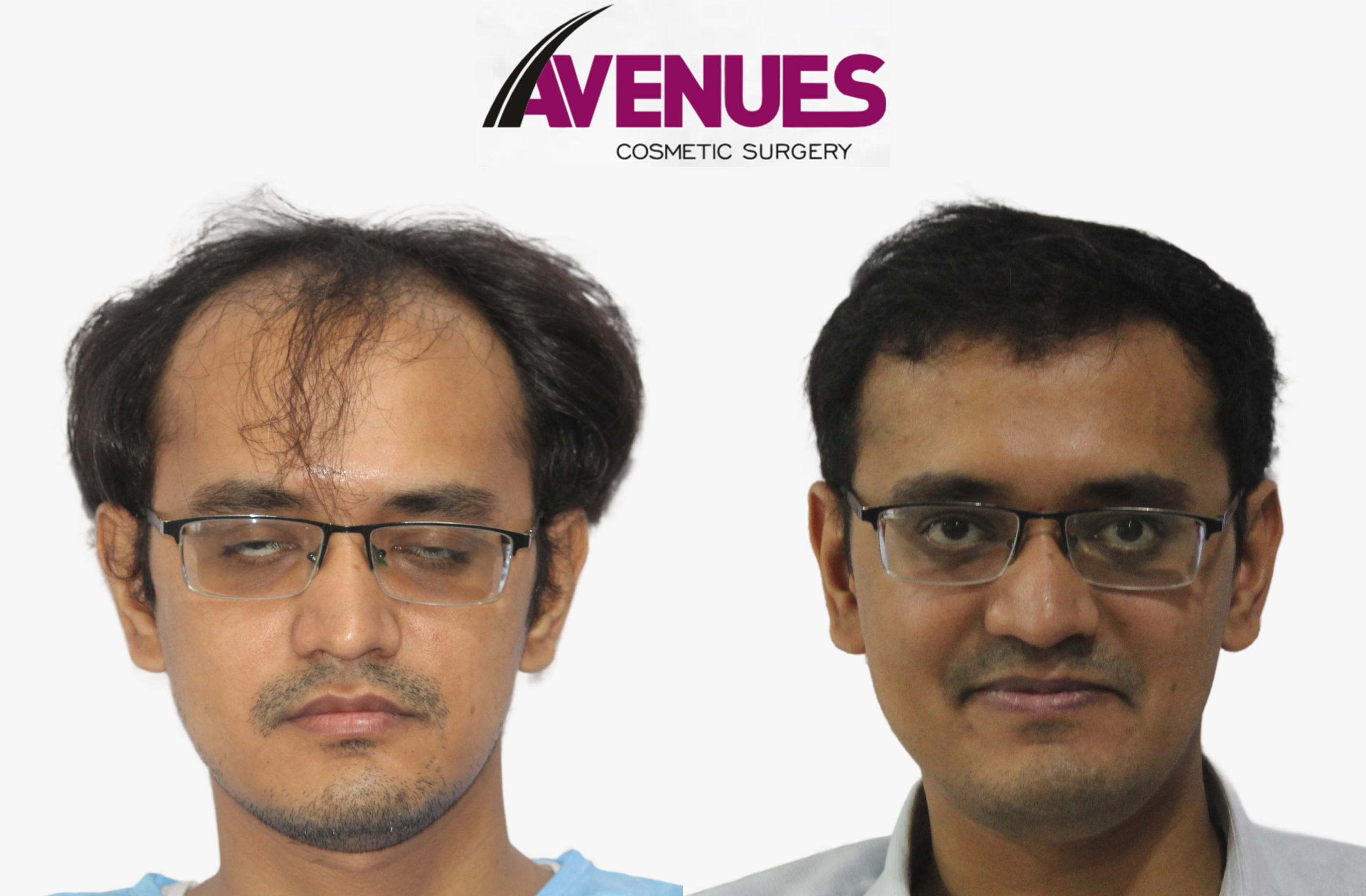 Parth mishra grade-before after