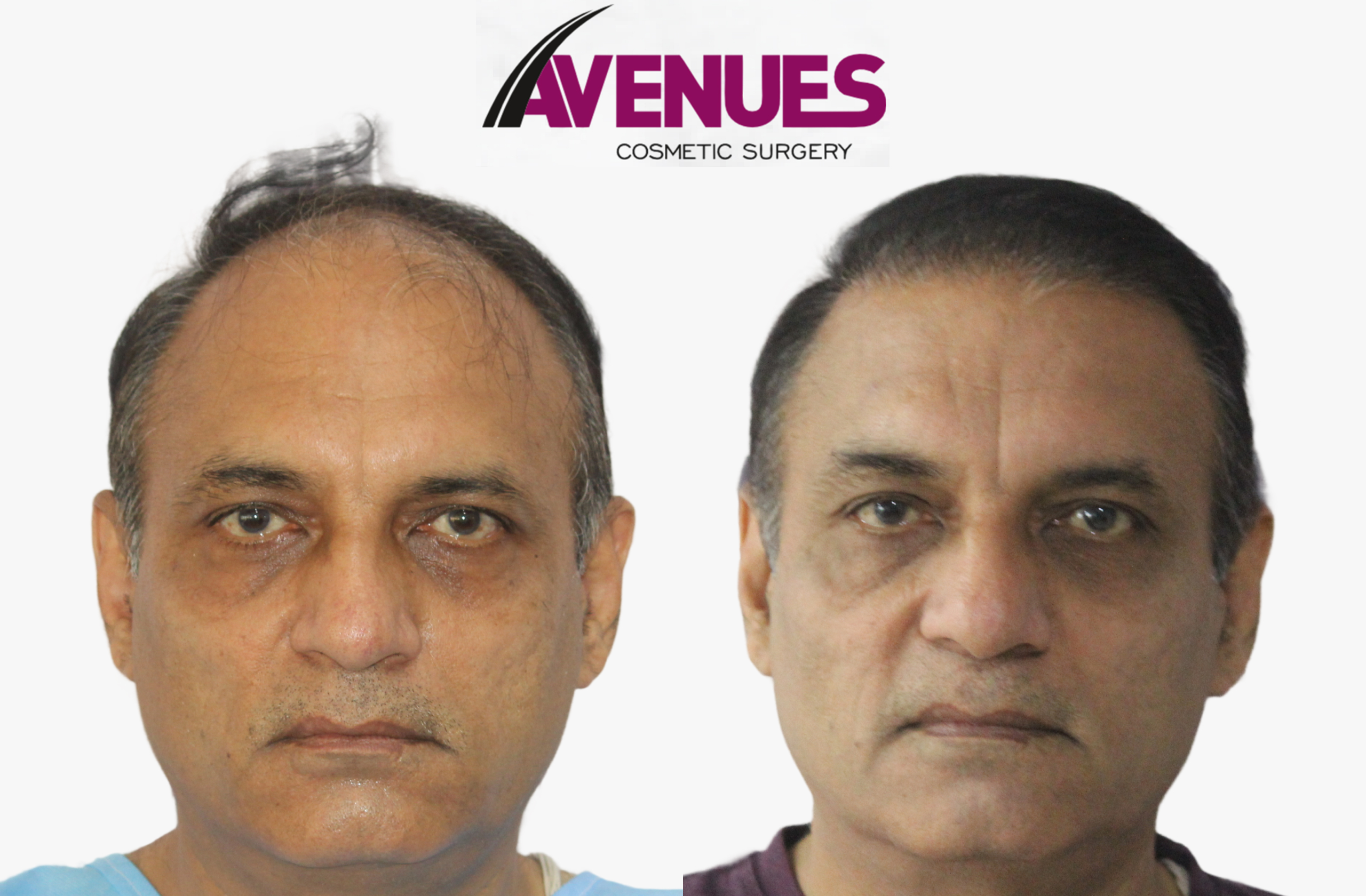 sunil raval-before after