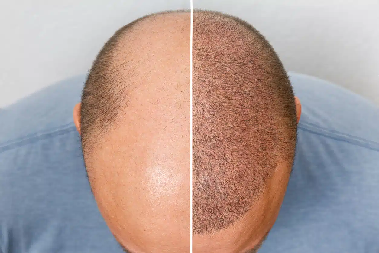 Hair Transplant Surgery: Post-Operative Instructions