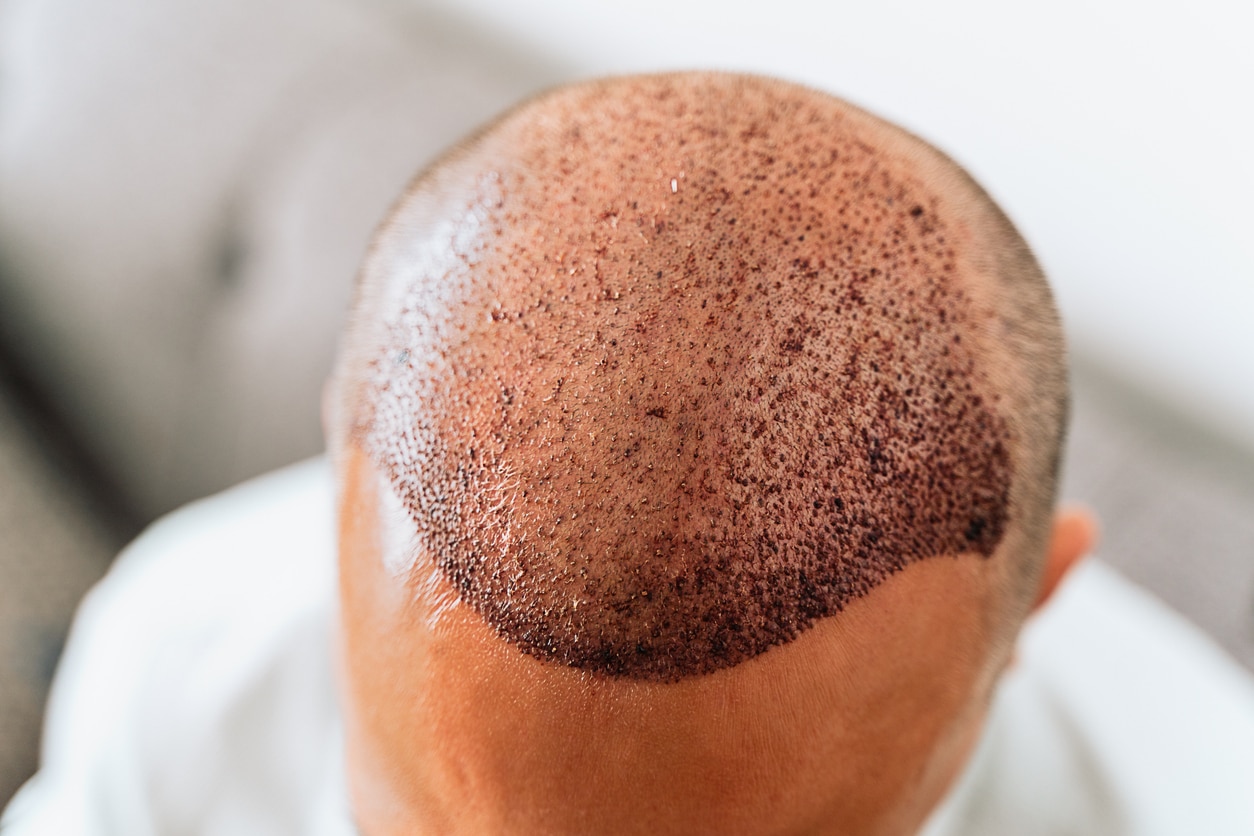 Doctor-Led vs. Technician-Driven Hair Transplants: Why Your Hair Surgeon’s Hands Make or Break Your Results