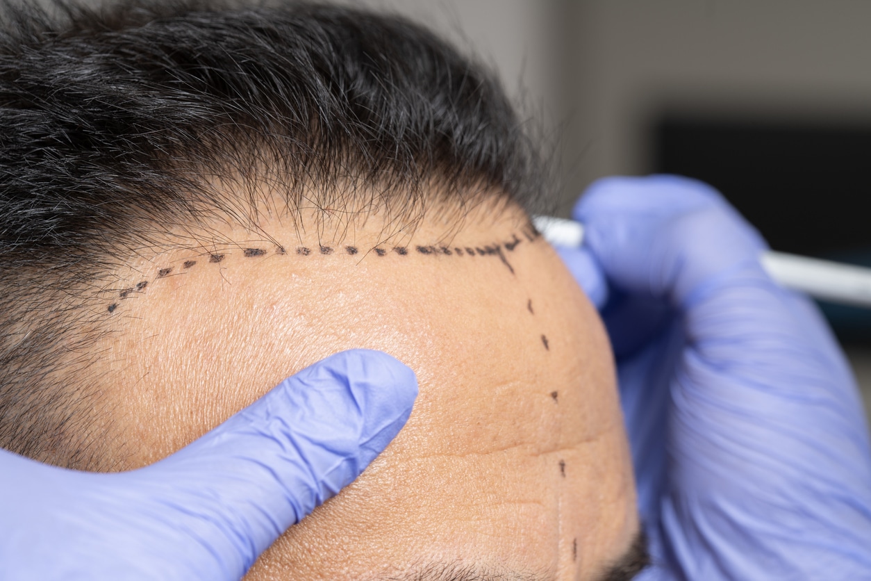 Hair Transplant Preparation: Pre-Surgery Steps