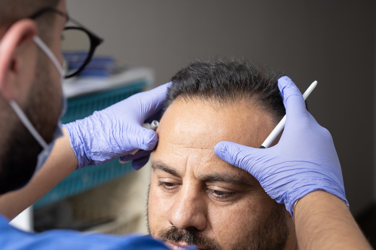 Hair Transplant Preparation: Pre-Surgery Steps