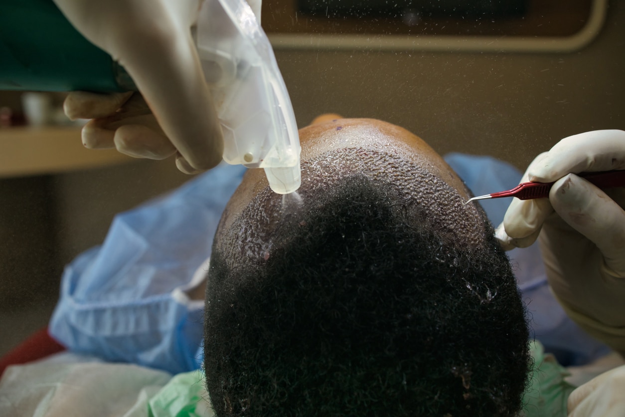 Hair Transplant