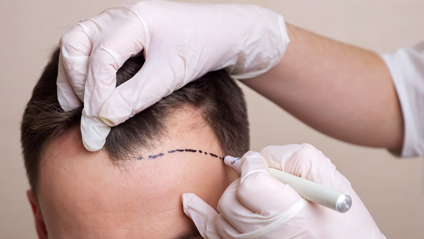 Exosome Therapy vs. PRP vs. PRF: What Works Best After a Hair Transplant?